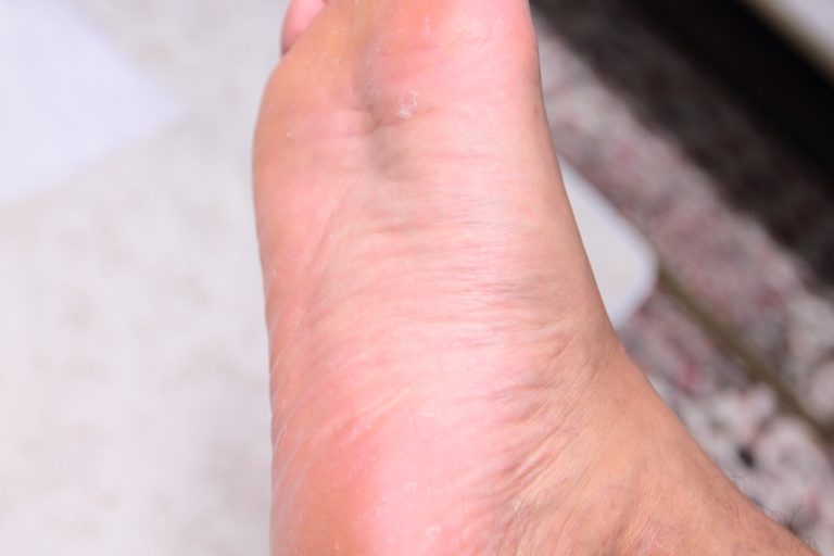 신발에 넣기만 하면 해결되는 발냄새없애는법, 무좀치료법 – 발냄새 제거깔창 신기깔창